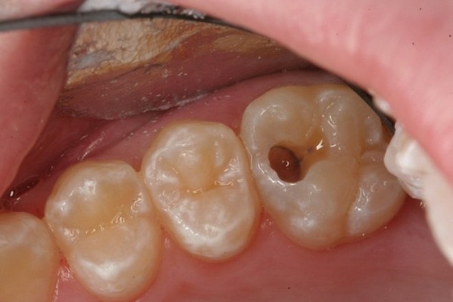 Răng có lỗ sâu to mà để lâu sẽ dẫn đến những biến chứng gì? - Ảnh 1.