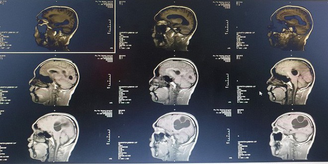 Phát hiện ổ sán não khổng lồ cư trú trong não một nam giới - Ảnh 1.