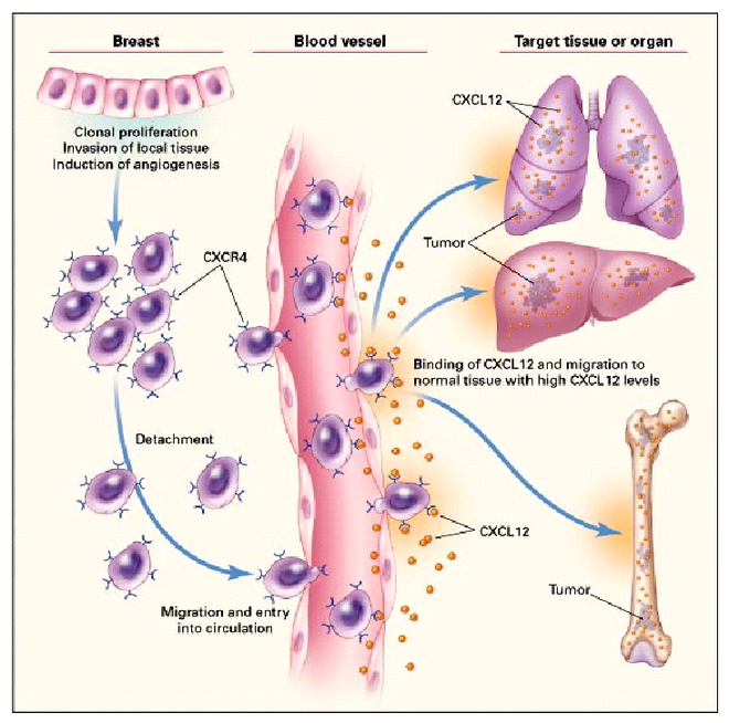 Những triệu chứng cho thấy ung thư vú di căn sang phổi và các cách để phòng tránh - Ảnh 3.