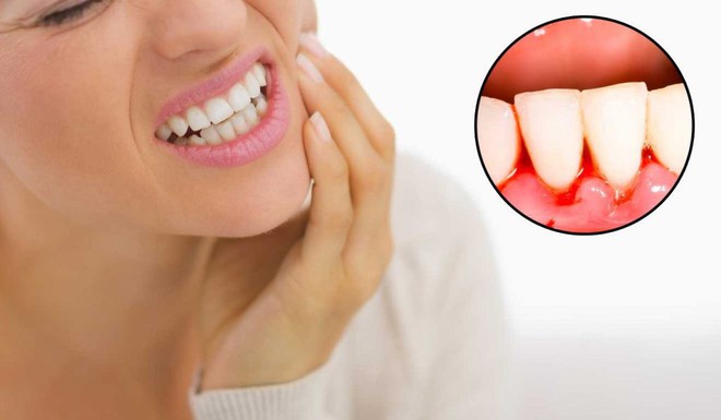 Những cách để giảm chảy máu răng ngay lập tức và ngăn chặn hiện tượng này phát sinh trong tương lai - Ảnh 2.