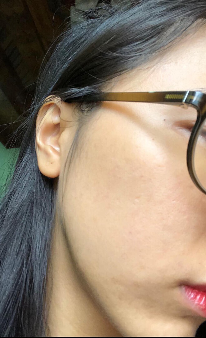 C&ocirc; n&agrave;ng n&agrave;y đ&atilde; chữa mụn ẩn do nấm th&agrave;nh c&ocirc;ng nhờ dầu gội trị g&agrave;u v&agrave; loại nước l&aacute; rẻ b&egrave;o n&agrave;y - Ảnh 3.