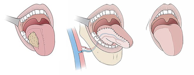 Tưởng là bị nhiệt lưỡi, ngờ đâu lại là dấu hiệu cảnh báo bệnh ung thư mà nhiều người không hay biết - Ảnh 3.