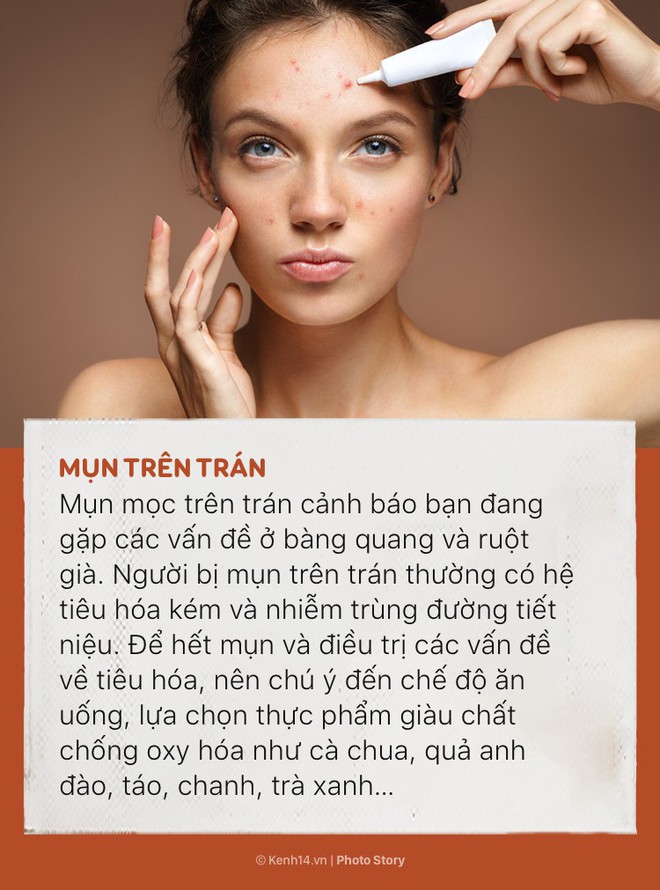 Đằng sau 6 vị tr&iacute; mụn n&agrave;y l&agrave; những dấu hiệu cảnh b&aacute;o t&igrave;nh trạng sức khỏe của cơ thể - Ảnh 1.