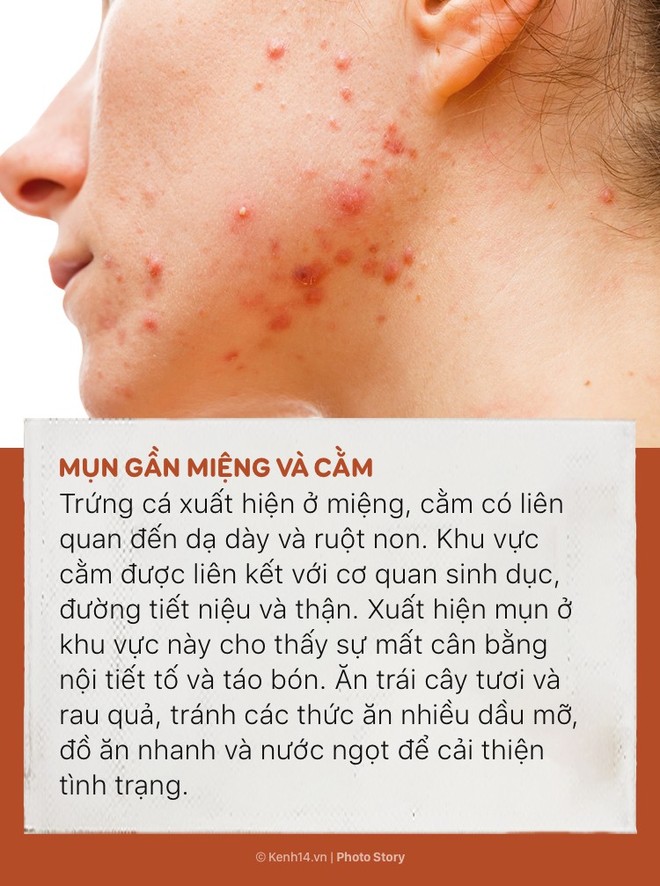 Đằng sau 6 vị tr&iacute; mụn n&agrave;y l&agrave; những dấu hiệu cảnh b&aacute;o t&igrave;nh trạng sức khỏe của cơ thể - Ảnh 3.
