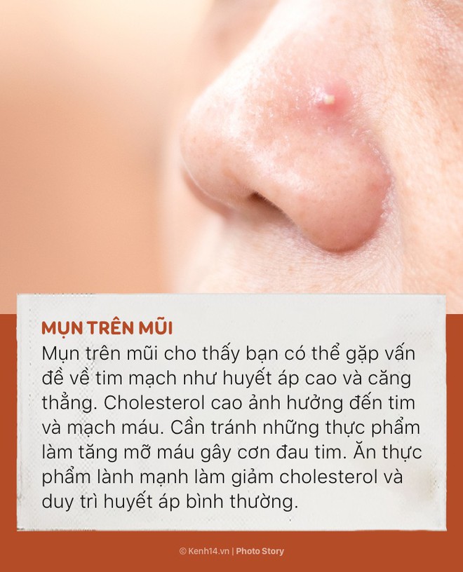 Đằng sau 6 vị tr&iacute; mụn n&agrave;y l&agrave; những dấu hiệu cảnh b&aacute;o t&igrave;nh trạng sức khỏe của cơ thể - Ảnh 7.