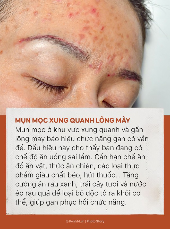 Đằng sau 6 vị trí mụn này là những dấu hiệu cảnh báo tình trạng sức khỏe của cơ thể - Ảnh 11.