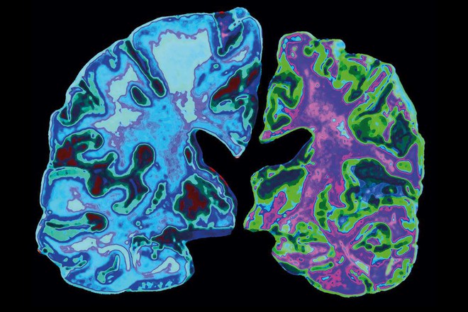 Giới trẻ tăng nguy cơ mắc bệnh Alzheimer chỉ v&igrave; 6 th&oacute;i quen hầu như ai cũng mắc phải - Ảnh 3.