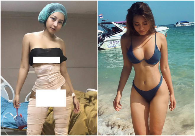 Hot girl bốc lửa Thái Lan bất ngờ công khai ảnh phẫu thuật để có eo con kiến, điều đáng nói đây không phải lần đầu cô lột xác  - Ảnh 1.