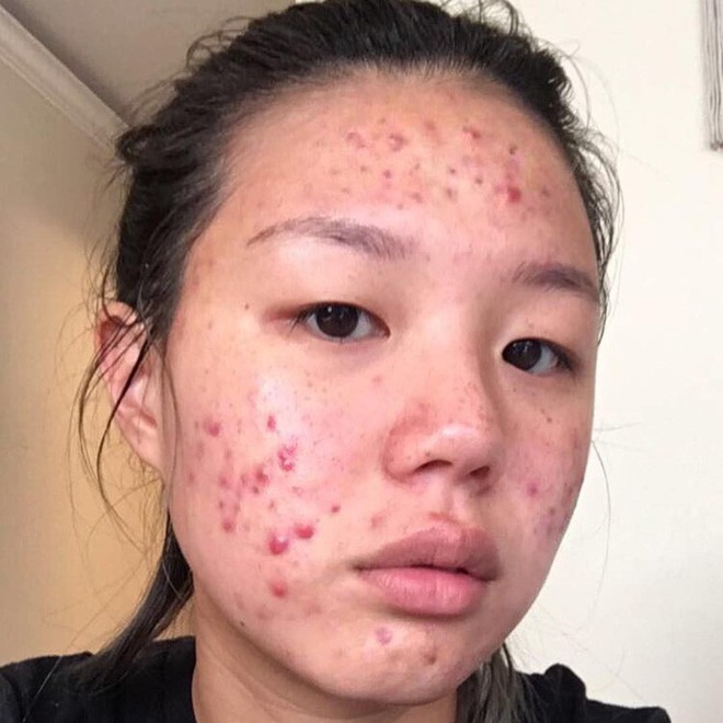 Blogger H&agrave;n Quốc từng bị mụn bọc chi ch&iacute;t chia sẻ b&iacute; k&iacute;p trị mụn trong v&agrave;i th&aacute;ng với 4 sản phẩm chủ chốt - Ảnh 1.