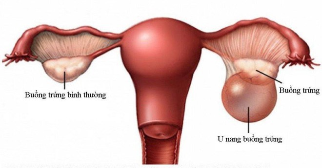 Bị đau bụng dữ dội mỗi khi tới tháng, cô gái phát hiện ra căn bệnh thường hay gặp phải nhưng dễ bị bỏ qua - Ảnh 5.