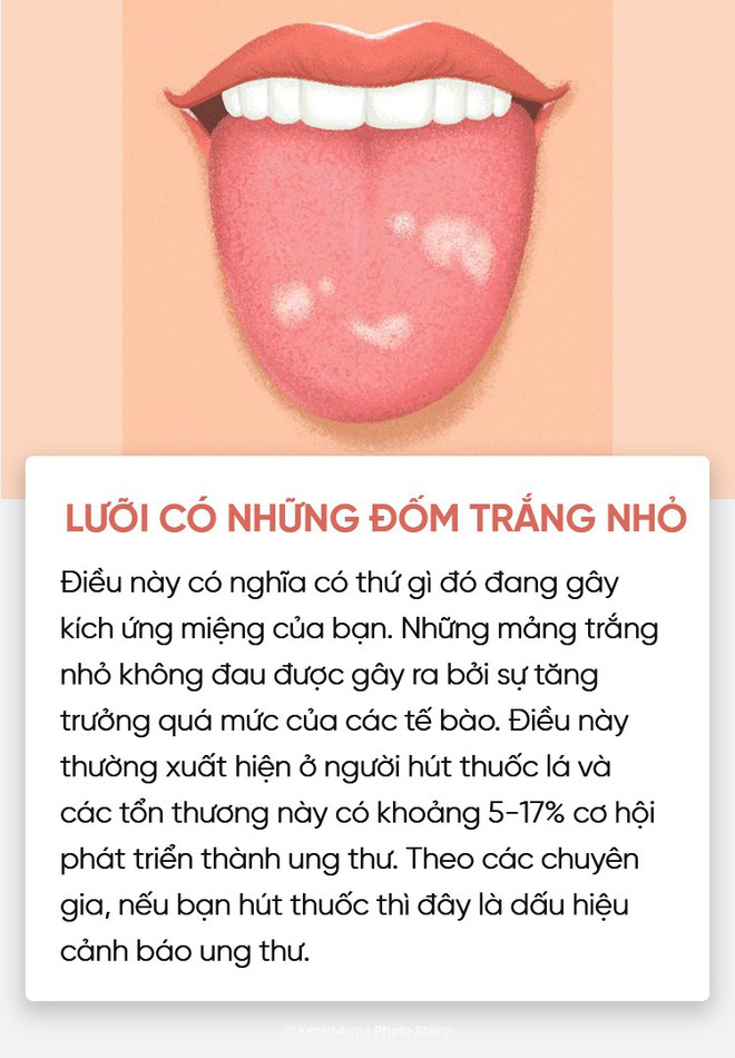 Đoán nhanh tình trạng sức khoẻ của bạn thông qua màu sắc, trạng thái lưỡi - Ảnh 7.