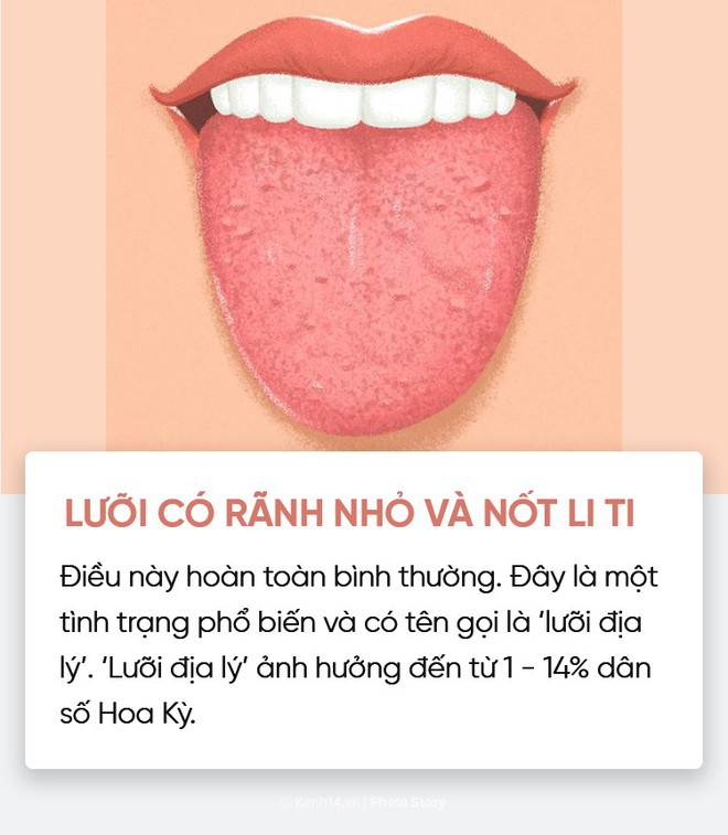 Đoán nhanh tình trạng sức khoẻ của bạn thông qua màu sắc, trạng thái lưỡi - Ảnh 11.