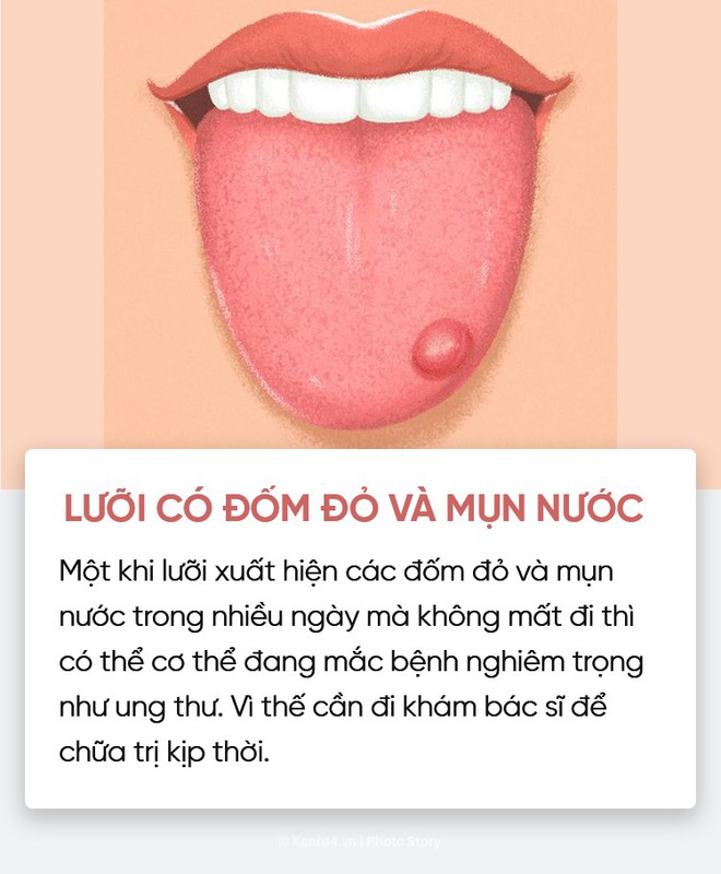 Đoán nhanh tình trạng sức khoẻ của bạn thông qua màu sắc, trạng thái lưỡi - Ảnh 15.