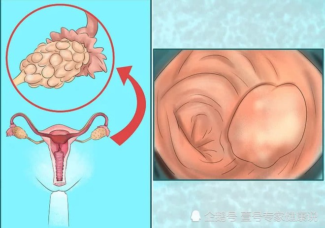 Cô gái 17 tuổi đột nhiên thấy râu ria mọc bất thường, nguyên nhân đến từ căn bệnh phụ khoa chẳng ai ngờ tới - Ảnh 3.