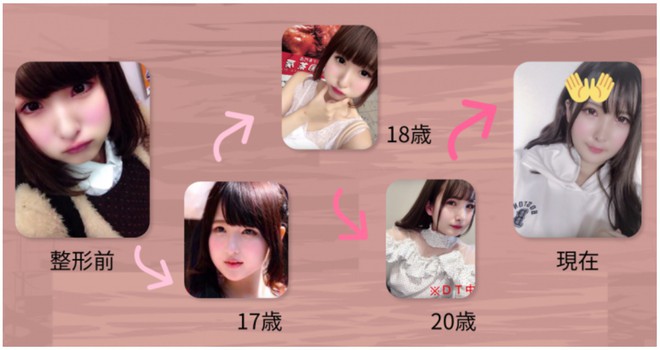 Chỉ v&igrave; một c&acirc;u n&oacute;i của bố, c&ocirc; g&aacute;i n&agrave;y đ&atilde; quyết định chi 3,1 tỉ để phẫu thuật thẩm mỹ - Ảnh 3.