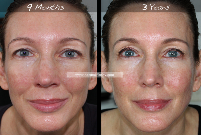 Đắn đo trước hiệu quả chống già của retinol? Minh chứng người phụ nữ sau 3 năm kiên trì với làn da như photoshop sẽ khiến bạn vững tin - Ảnh 6.