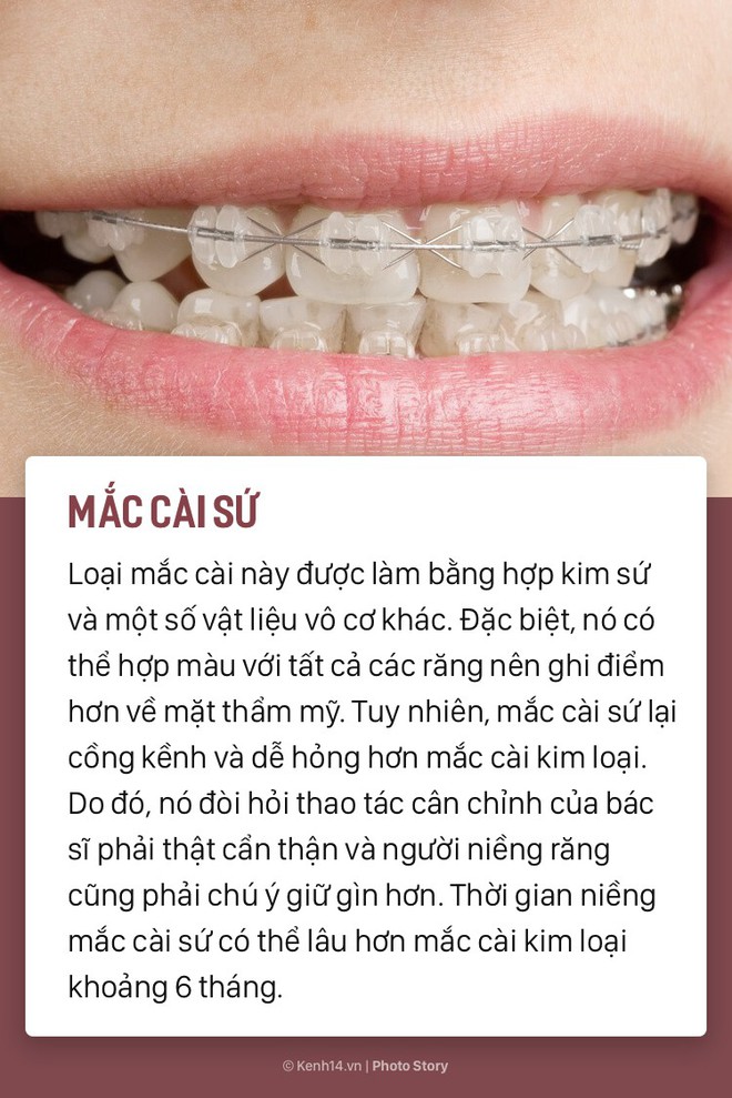 Chỉ l&agrave; niềng răng th&ocirc;i m&agrave; cũng c&oacute; rất nhiều phương ph&aacute;p, loại h&igrave;nh kh&aacute;c nhau để c&aacute;c bạn lựa chọn - Ảnh 3.