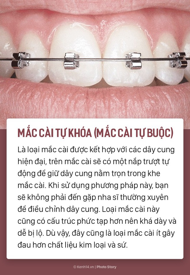 Chỉ l&agrave; niềng răng th&ocirc;i m&agrave; cũng c&oacute; rất nhiều phương ph&aacute;p, loại h&igrave;nh kh&aacute;c nhau để c&aacute;c bạn lựa chọn - Ảnh 5.