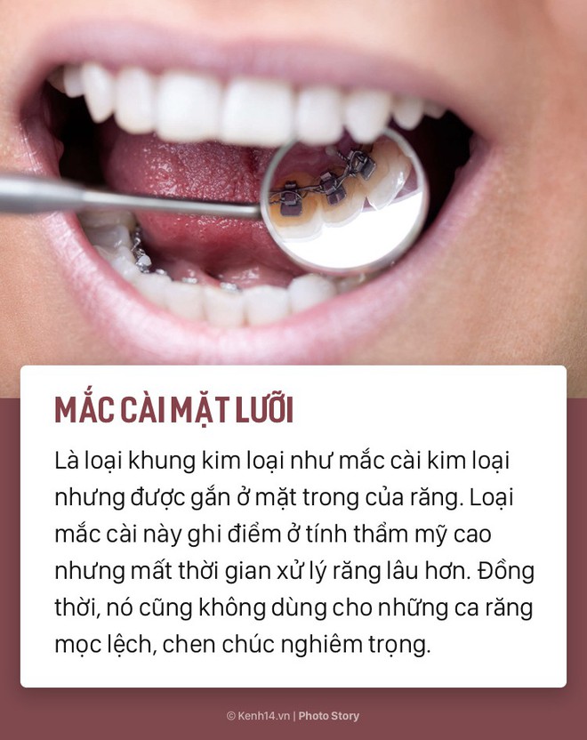 Chỉ l&agrave; niềng răng th&ocirc;i m&agrave; cũng c&oacute; rất nhiều phương ph&aacute;p, loại h&igrave;nh kh&aacute;c nhau để c&aacute;c bạn lựa chọn - Ảnh 7.
