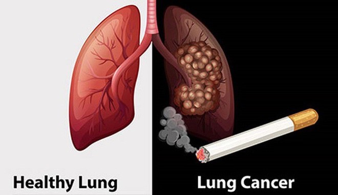 Cảnh báo: Gần 97% số ca ung thư phổi tại Việt Nam có hút thuốc lá - Ảnh 1.