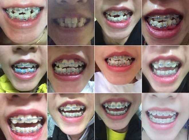 Sau pha niềng răng chấn động MXH, nhiều bạn trẻ không ngại chia sẻ hình ảnh vịt hoá thiên nga với hàm răng của mình - Ảnh 6.