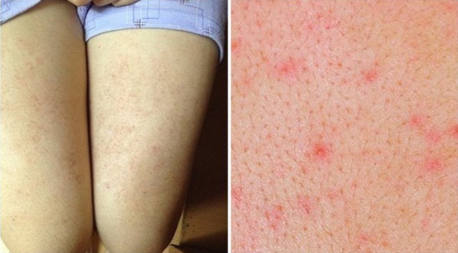 Cẩn thận với những căn bệnh về da thường gặp trong mùa hè, đặc biệt là bệnh số 3 - Ảnh 3. Cẩn thận với những căn bệnh về da thường gặp trong mùa hè, đặc biệt là bệnh số 3 - Ảnh 3.
