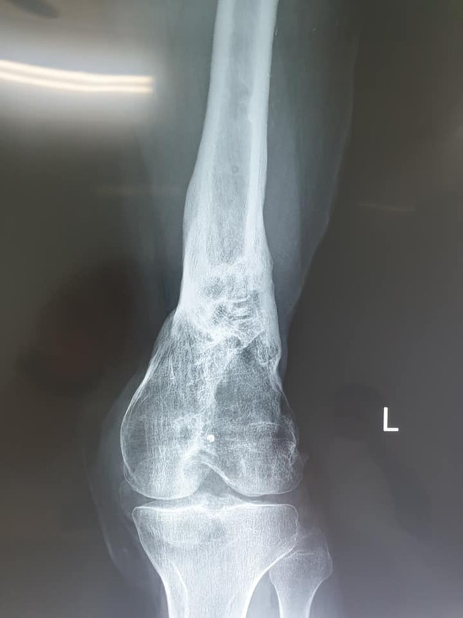 Hành trình 5 năm, 7 lần phẫu thuật cứu chân dập nát cho cậu sinh viên 19 tuổi của các y bác sĩ bệnh viện Việt Đức - Ảnh 9.