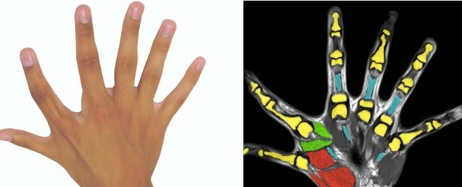Dành cho những người mắc chứng thừa ngón: Liệu bàn tay nhiều hơn 5 ngón có hoạt động tốt hơn bình thường? - Ảnh 1.