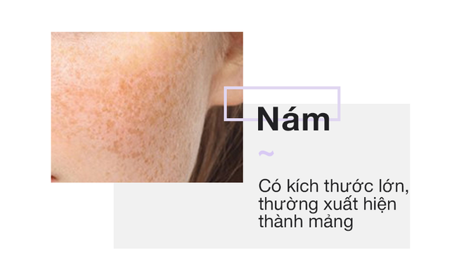 Chỉ cần nh&igrave;n v&agrave;o 2 b&ecirc;n g&ograve; m&aacute; sẽ biết ngay bạn đang bị n&aacute;m hay đốm n&acirc;u - Ảnh 2.