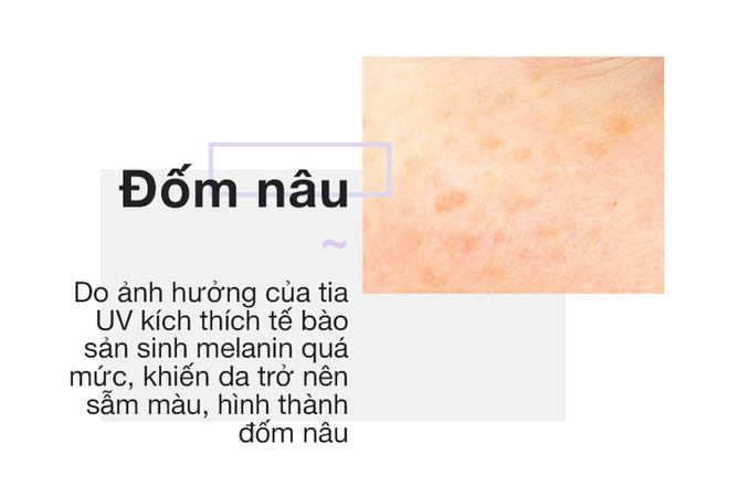 Chỉ cần nh&igrave;n v&agrave;o 2 b&ecirc;n g&ograve; m&aacute; sẽ biết ngay bạn đang bị n&aacute;m hay đốm n&acirc;u - Ảnh 3.