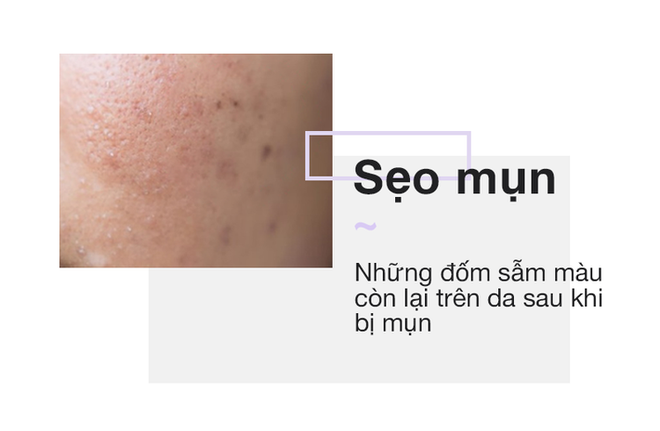 Chỉ cần nh&igrave;n v&agrave;o 2 b&ecirc;n g&ograve; m&aacute; sẽ biết ngay bạn đang bị n&aacute;m hay đốm n&acirc;u - Ảnh 4.