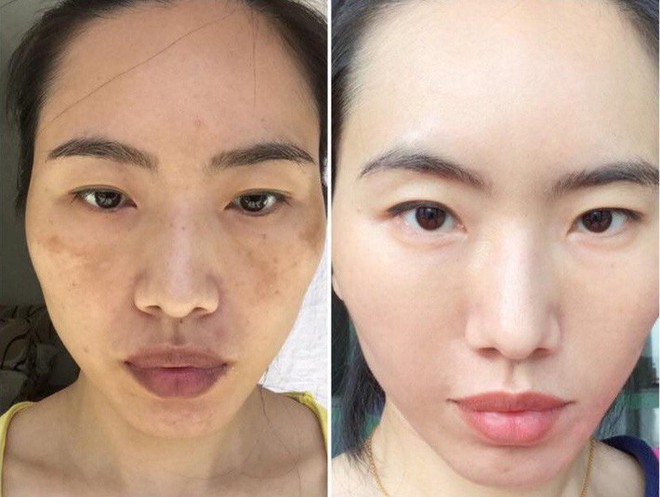 Chỉ cần nh&igrave;n v&agrave;o 2 b&ecirc;n g&ograve; m&aacute; sẽ biết ngay bạn đang bị n&aacute;m hay đốm n&acirc;u - Ảnh 5.