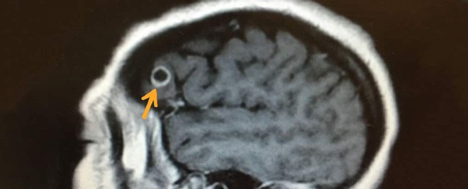 Trong khi tìm kiếm khối u, bác sĩ tìm thấy vị khách không mời kinh khủng trong não của một phụ nữ - Ảnh 2.