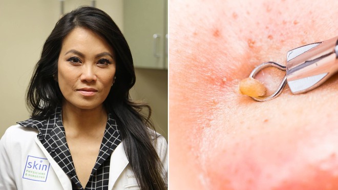 Cùng xem Dr. Pimple Popper vét mười mấy chiếc mụn mủ như sữa chua trên lưng người thanh niên - Ảnh 1.