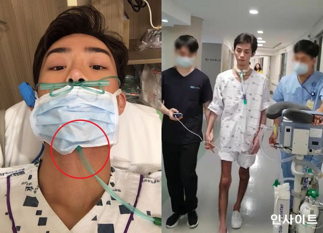 Đừng coi thường việc nuốt phải nước bể bơi, một thanh niên Hàn đã bị viêm phổi nghiêm trọng sau khi gặp phải điều này - Ảnh 3.