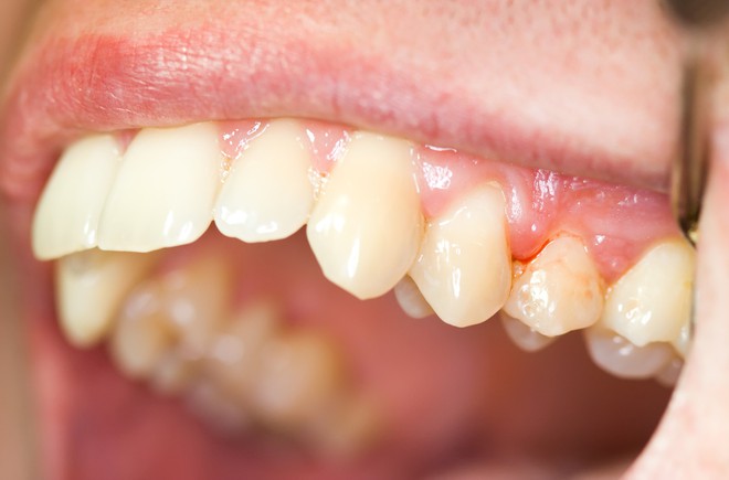 Những triệu chứng dễ thấy giúp cảnh báo bệnh ung thư gan có thể đang nhen nhóm trong cơ thể bạn - Ảnh 4. Những triệu chứng dễ thấy giúp cảnh báo bệnh ung thư gan có thể đang nhen nhóm trong cơ thể bạn - Ảnh 4.