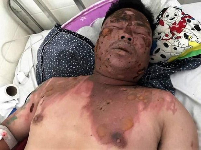 Hỏi tuổi bố bạn nhậu cho dễ xưng h&ocirc;, người đ&agrave;n &ocirc;ng bị hất cả nồi lẩu v&agrave;o mặt g&acirc;y bỏng nặng - Ảnh 1.