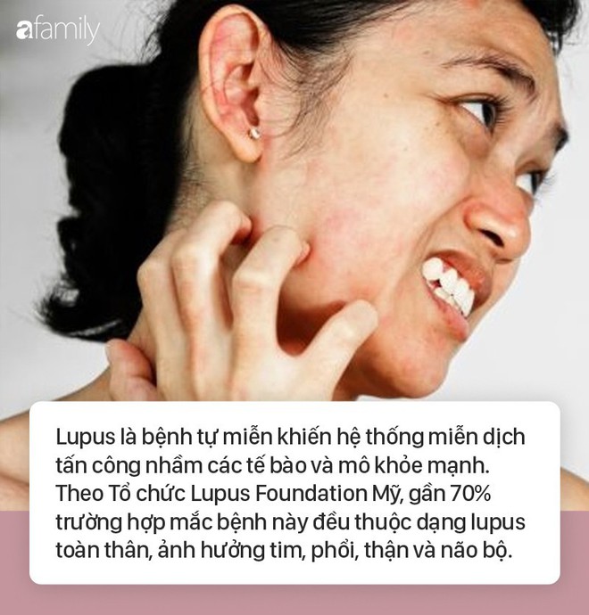 Những nguyên nhân phổ biến gây bệnh lupus không phải ai cũng biết rõ - Ảnh 1.