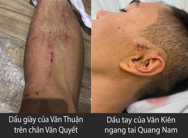 Hãi hùng với chấn thương của các cầu thủ thi đấu V.League: Ai nói bóng đá Việt nhàm chán và thiếu lửa? - Ảnh 1.