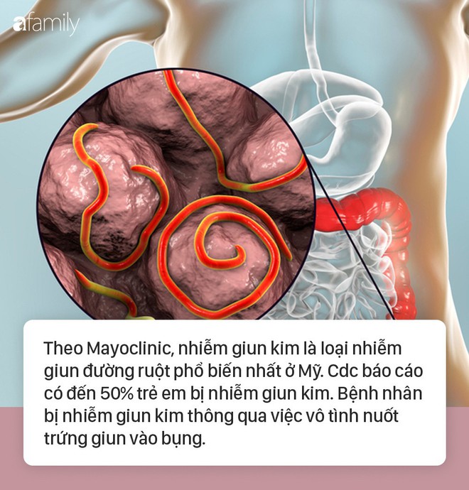 Kinh hãi về loài giun “bò lổn ngổn” quanh hậu môn người và chúng ta dễ bị lây trực tiếp qua quần áo, ga trải giường - Ảnh 1.