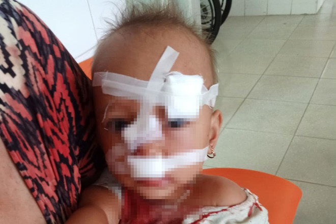 Bố mẹ c&atilde;i nhau, b&eacute; g&aacute;i 2 tuổi nhập viện, kh&acirc;u 12 mũi tr&ecirc;n mặt - Ảnh 2.