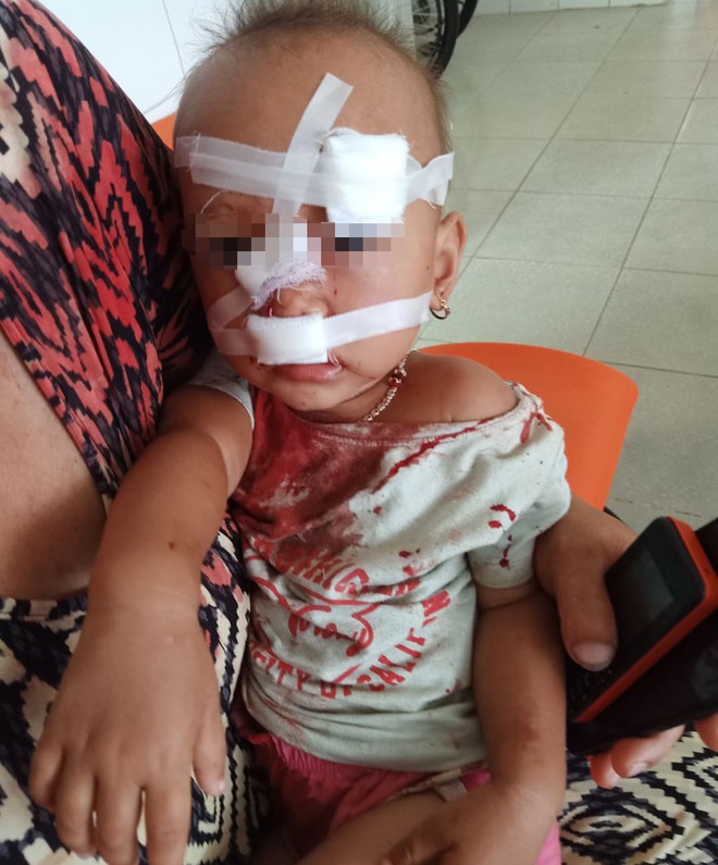 Mẹ bé gái bị cha ruột ném ly vào mặt, khâu 12 mũi: Lúc 13 tháng, con bé cũng bị ném vật cứng làm chấn thương sọ não - Ảnh 2.