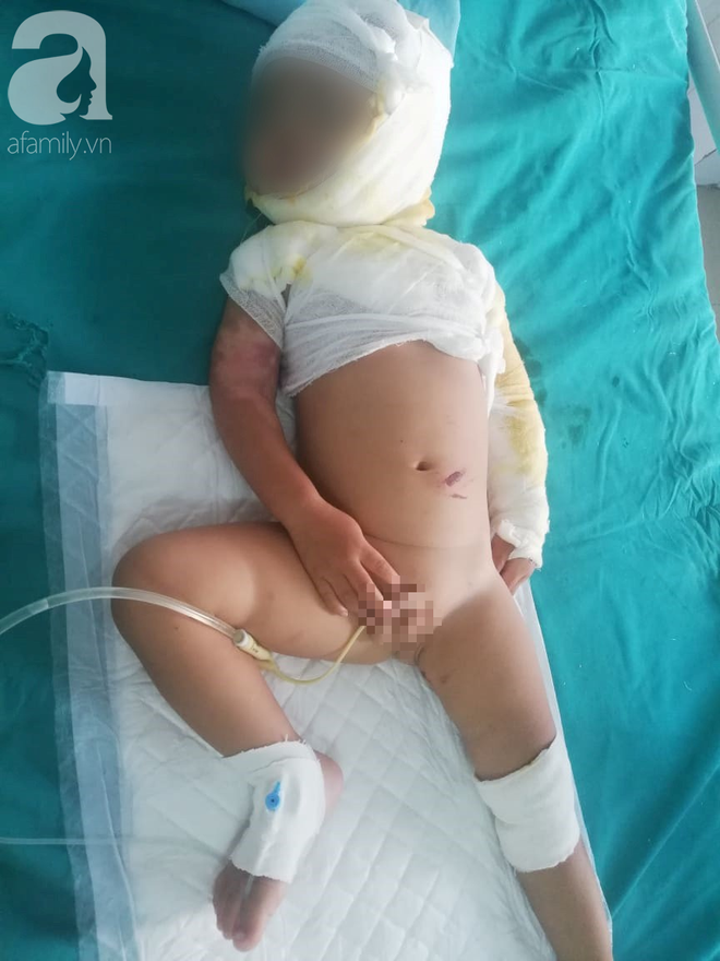 Vụ chồng tẩm xăng thi&ecirc;u sống cả nh&agrave; v&igrave; vợ dỗ con kh&ocirc;ng n&iacute;n: Người mẹ hoảng loạn, b&eacute; trai 2 tuổi bị nhiễm tr&ugrave;ng nặng - Ảnh 6.