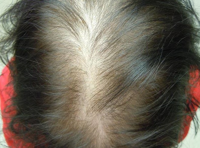 Cẩn thận với những biểu hiện cho thấy bạn đang rụng tóc ở tình trạng đáng báo động - Ảnh 2.