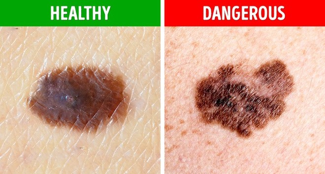 Bạn sẽ không nghĩ rằng mình có nguy cơ mắc bệnh ung thư da sau khi nhìn thấy nốt ruồi có 5 biểu hiện lạ này - Ảnh 2.