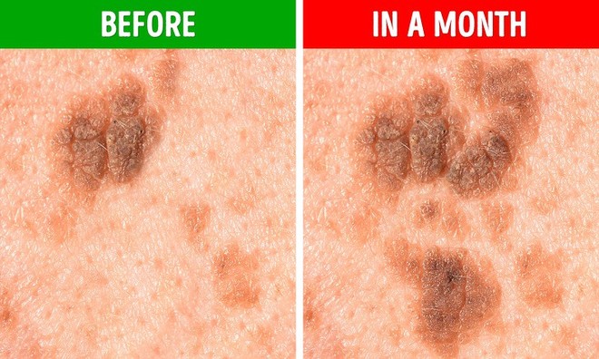 Bạn sẽ không nghĩ rằng mình có nguy cơ mắc bệnh ung thư da sau khi nhìn thấy nốt ruồi có 5 biểu hiện lạ này - Ảnh 5.