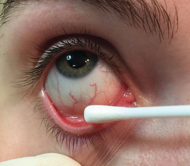 Chàng trai 20 tuổi mắc bệnh lây truyền qua đường tình dục nhưng triệu chứng lại xuất hiện ở... mắt - Ảnh 1.