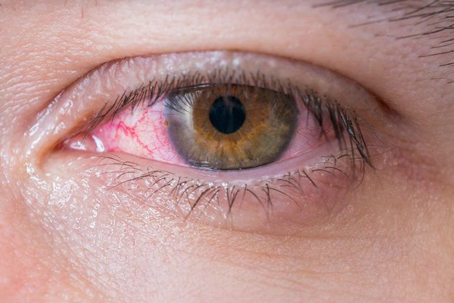 Chàng trai 20 tuổi mắc bệnh lây truyền qua đường tình dục nhưng triệu chứng lại xuất hiện ở... mắt - Ảnh 3.