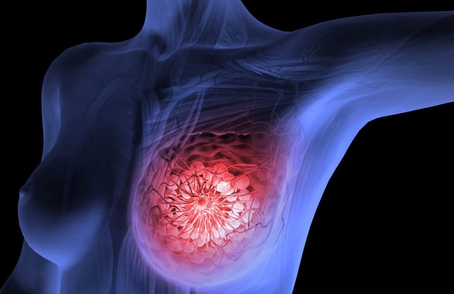 Cách tự kiểm tra ung thư vú tại nhà: tưởng khó nhưng lại rất dễ để bạn tự thực hiện mỗi tháng - Ảnh 1.