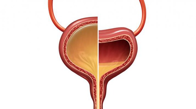 Không chỉ gây ra sỏi thận, nhịn tiểu quá lâu còn có thể gây vỡ bàng quang, nhiễm trùng đường tiết niệu - Ảnh 2.